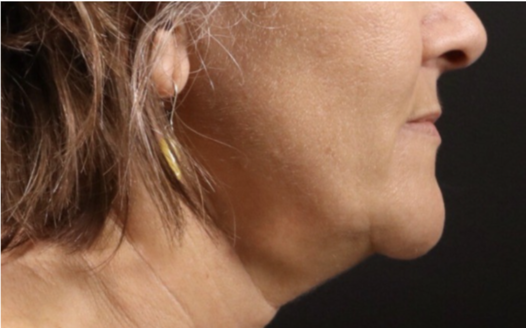 Best Facial Exercises To Get Rid Of Sagging Jowls best-facial-exercises-to-get-rid-of-sagging-jowls